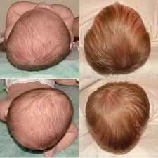 Four baby heads seen from above: the two on the left are flattened at the back on one side; the two on the right are rounder.